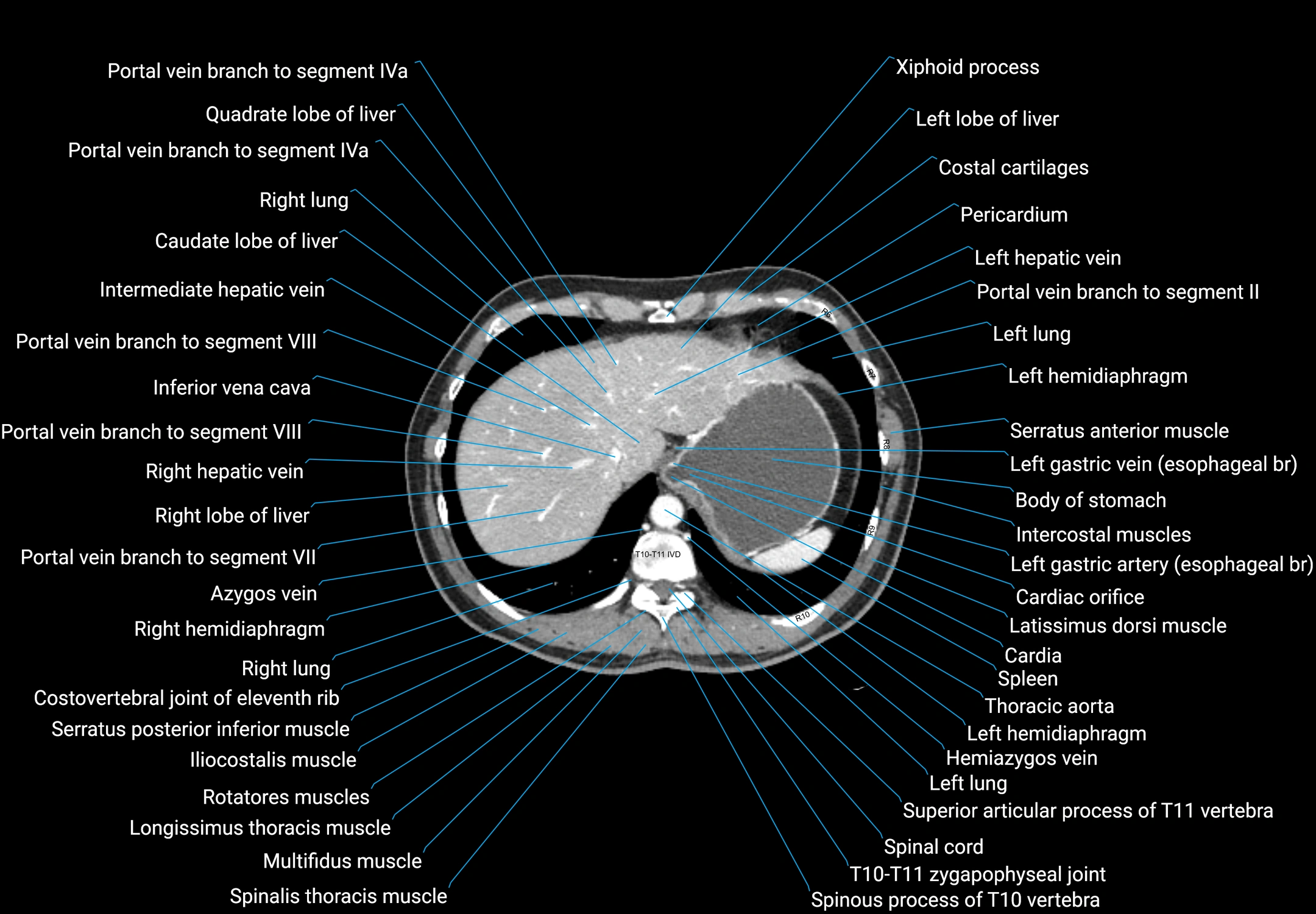 CT male pelvis axial cross sectional anatomy labelled radiology image -00020.webp